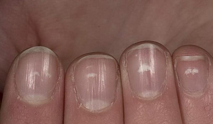 Почему становятся волнистые ногти и как это исправить Неровная ногтевая пластина на большом пальце