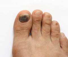 Вмятины и ямки на ногтях: причины, лечение